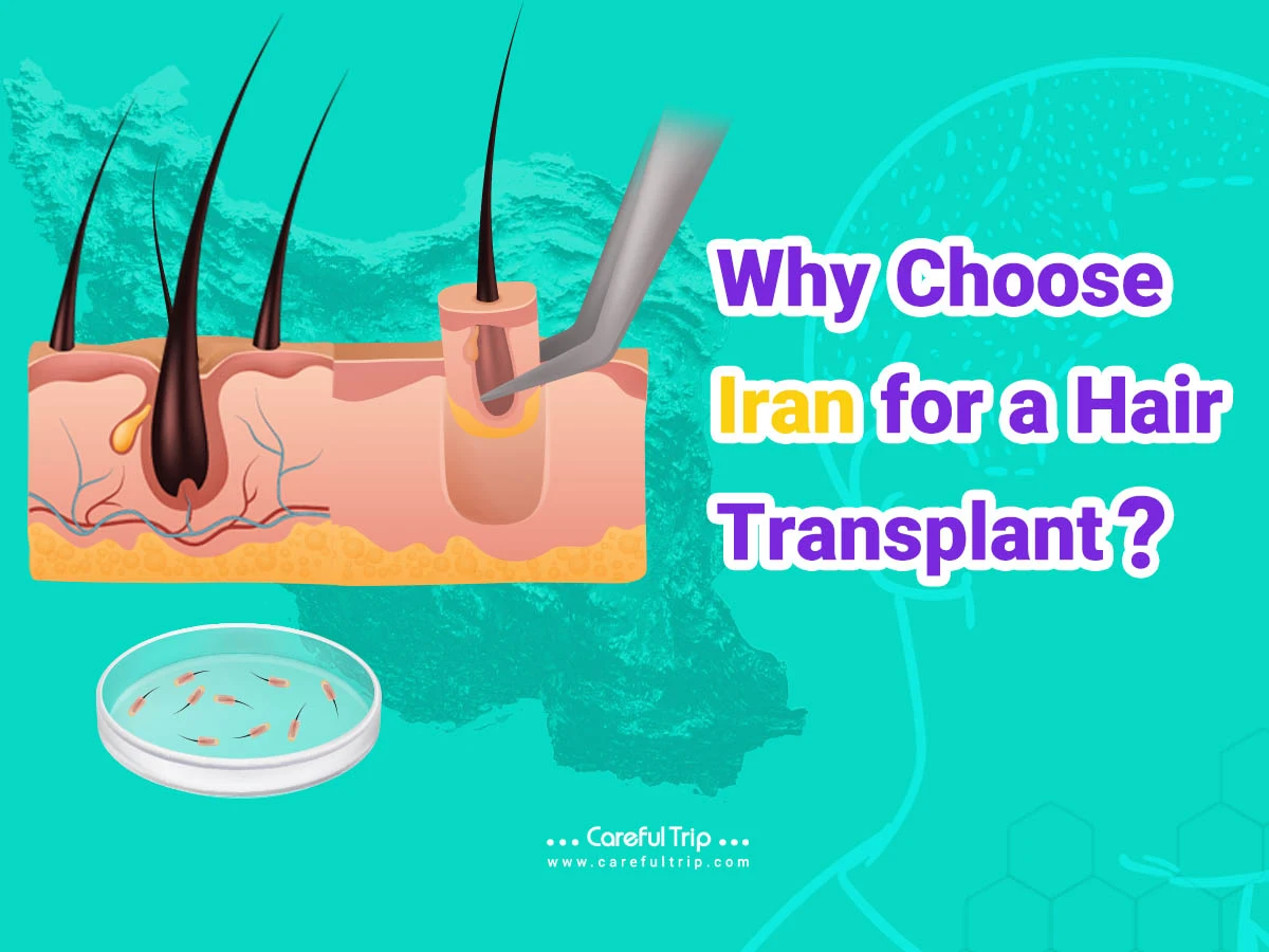 Why Choose Iran for a Hair Transplant?