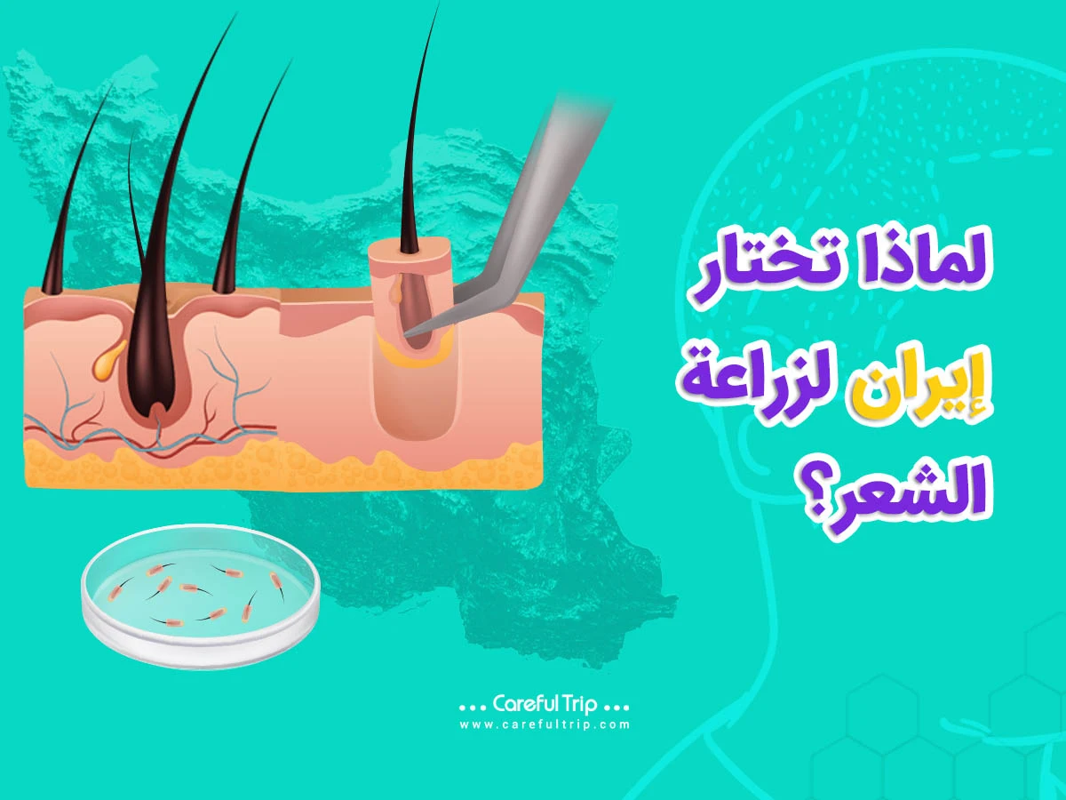 لماذا ايران لعملية زراعة الشعر؟