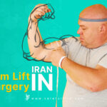 Arm Lift Surgery in Iran (Brachioplasty)