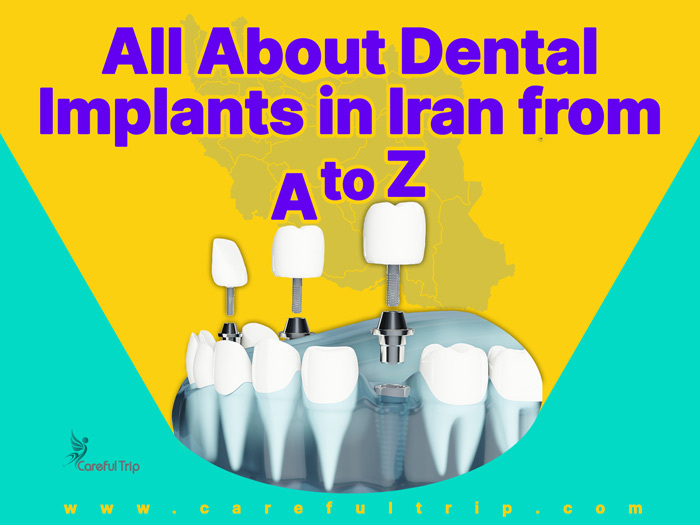 All about Dental Implants in Iran