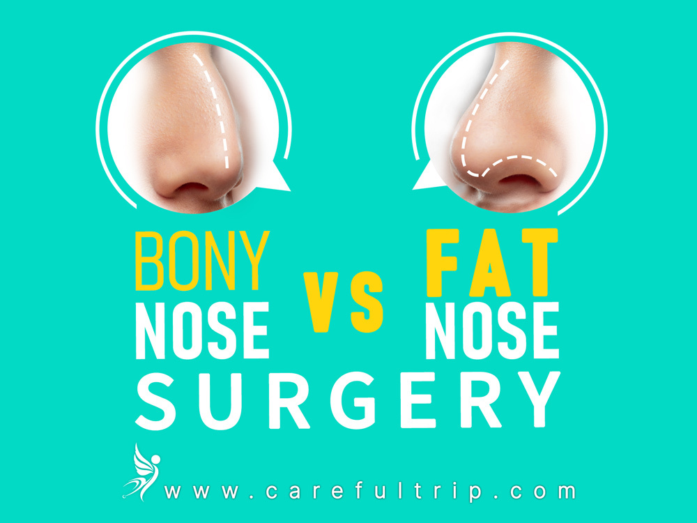 Bony Nose VS Fat Nose Surgery