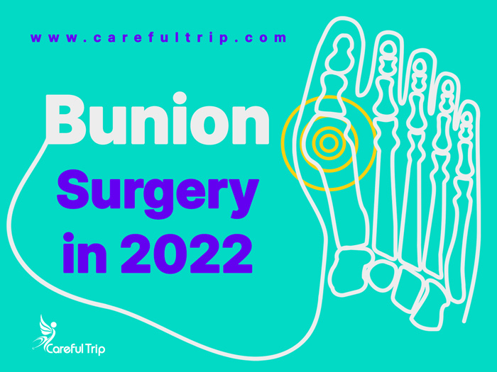 Bunion surgery in 2022