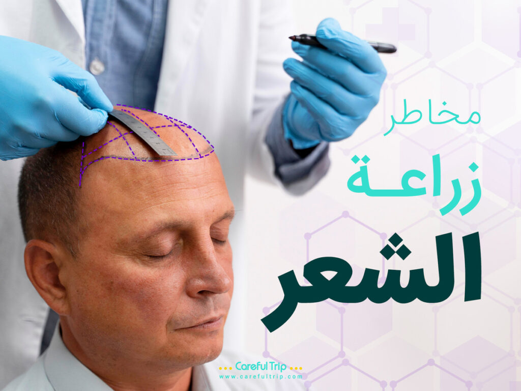 مخاطر زراعة الشعر