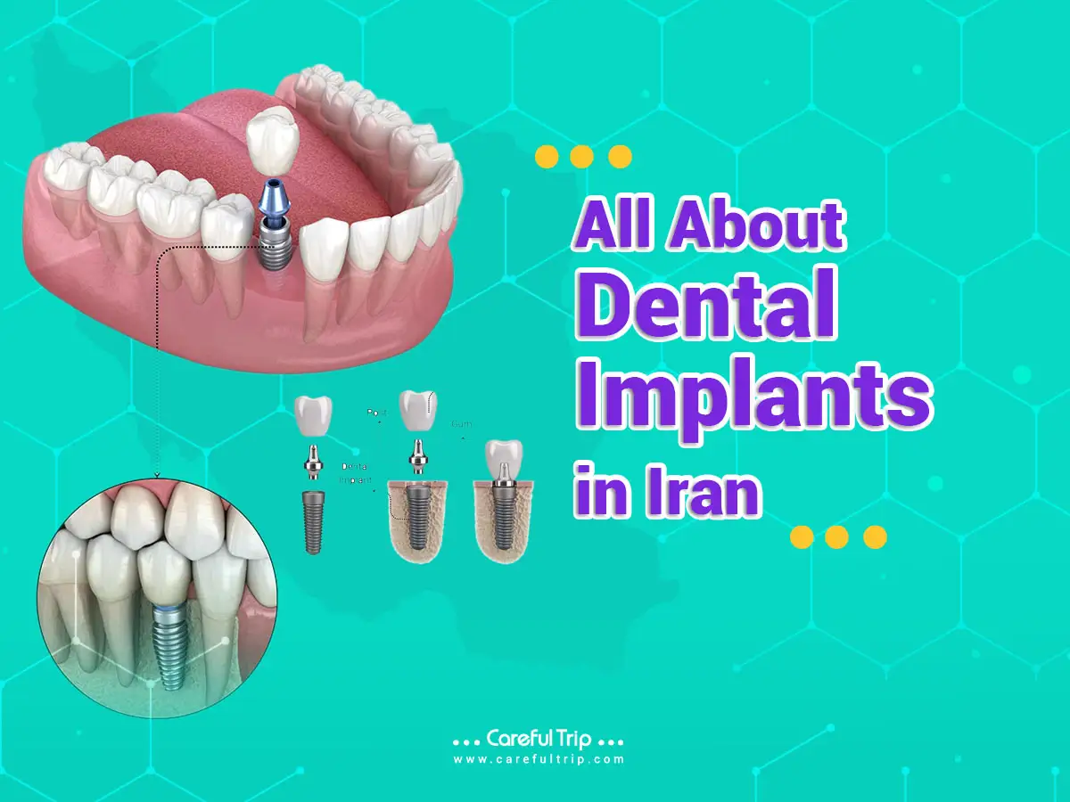 Dental Implants in Iran